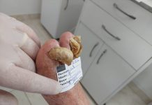 Saúde: Podologia Ferrari: Onicogrifose, saiba quais são as causas….